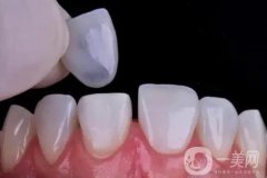 牙齒貼面有哪些類(lèi)型?