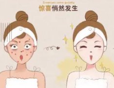 怎么去除臉上的斑點(diǎn)？