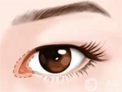 開眼角是否會(huì)導(dǎo)致疤痕？開眼角有哪些危害？