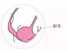 副乳切除后吃什么水果好？