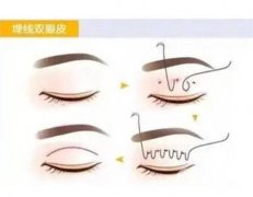 切開(kāi)雙眼皮手術(shù)后怎么護(hù)理，有什么副作用