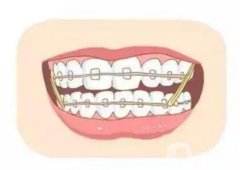 有哪些因素影響牙齒矯正的價(jià)格？