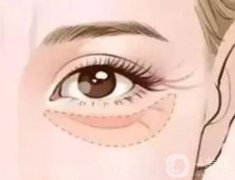 填充眼窩后恢復(fù)正常需要多長(zhǎng)時(shí)間，流程是怎么樣的