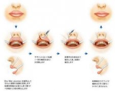 重唇修正前的注意事項(xiàng)?重唇修正后的注意事項(xiàng)?