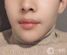 嘴唇外翻怎么矯正?唇外翻矯正術(shù)前的準(zhǔn)備有哪些?