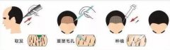 植發(fā)一般價格是多少?果如何?
