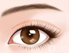 開眼角后的疤痕能否修復(fù)？開眼角疤痕消除需要多久