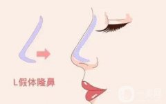 鞍鼻整形可以用什么材料？