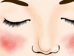 激光去除紅血絲的原理是什么，優(yōu)點是什么