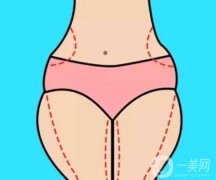 吸脂豐臀的方法有哪些？哪些類型適合吸脂豐臀？