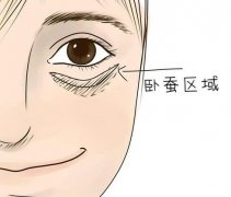 臥蠶注射玻尿酸會(huì)下移嗎？是否