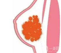 奧美定是什么？取出后的殘留物取會致癌嗎