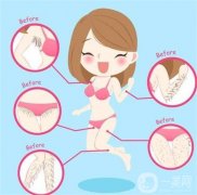 超冰脫毛與冰點(diǎn)脫毛的區(qū)別