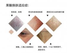 果酸換膚調(diào)節(jié)的間隔時間是多久？