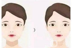 面部吸脂的果是*性的嗎？什么情況會反彈