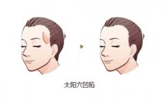 太陽穴凹陷怎么辦？太陽穴填充要多少錢？