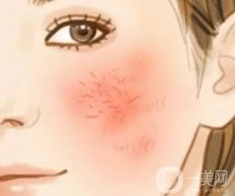 激光調(diào)節(jié)紅血絲多少錢？