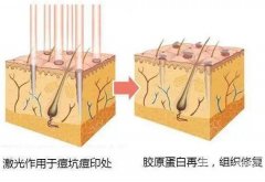 做激光點陣疼嗎，可以用麻藥嗎？