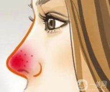 怎么調(diào)節(jié)酒渣鼻？酒渣鼻的調(diào)節(jié)方法是什么？