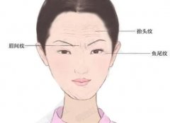 有哪些去除眉間皺紋的方法？