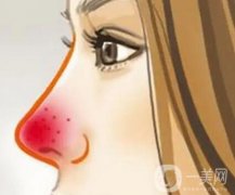 酒糟鼻不同時(shí)期的調(diào)節(jié)方法