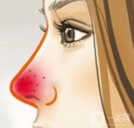 酒渣鼻的預(yù)防與護(hù)理？