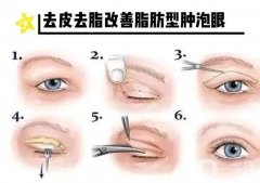 什么是腫泡眼重瞼術(shù)？有哪些方法