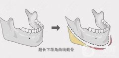 下頜角切除通常是多少錢?它有什么優(yōu)勢呢?