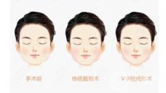 磨骨手術(shù)是怎么操作的?磨骨手術(shù)有后遺癥嗎?