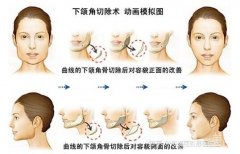 下頜骨整形是怎么做的?下頜整形能讓你好看嗎?