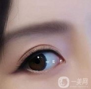 雙眼皮手術(shù)方法有哪些?雙眼皮手術(shù)適合人群?