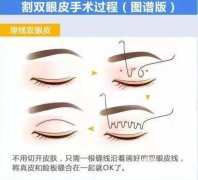 三點埋線經(jīng)久不衰嗎?為什么價格差距這么大?