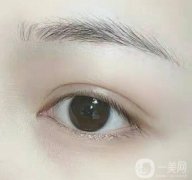 微創(chuàng)定位雙眼皮持久嗎?微創(chuàng)雙眼皮手術(shù)的特點