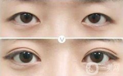 切開雙眼皮是*的嗎?埋線好還是切開雙眼皮比較好?