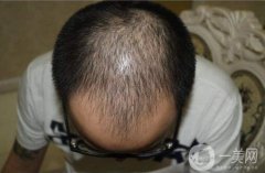 生姜能夠調(diào)節(jié)脂溢性脫發(fā)嗎?