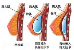 假體隆胸會影響健康嗎?