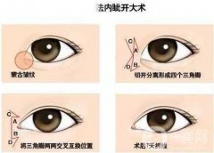 南京開內(nèi)眼角手術(shù)后會有疤痕嗎?