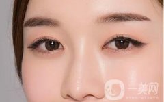 什么樣的人適合開眼角?