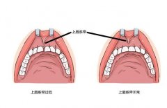 唇系帶整形手術的方法和步驟？
