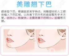 下巴整形有哪些選擇?下巴整形怎么做?