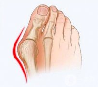 大腳骨糾正的手術(shù)調(diào)節(jié)方式有哪些?大腳骨糾正的病發(fā)癥有哪些?