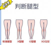 什么是O型腿?O型腿矯正方法有哪些?