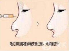 北京注射隆鼻多少錢?注射隆鼻價(jià)格與哪些因素有關(guān)?