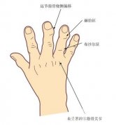手指屈曲畸形有哪些表現(xiàn)?手指屈曲畸形的調(diào)節(jié)需要注意的有哪些?