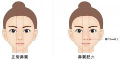 鼻子鼻翼縮小手術(shù)價(jià)格?鼻翼縮小術(shù)有什么后遺癥?