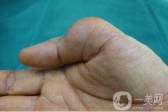 先天性手指屈曲畸形怎么辦?