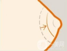 產(chǎn)后如何淡化乳暈顏色?乳暈霜有副作用嗎?