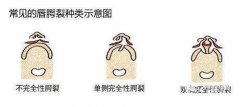 唇腭裂怎么辦?修復(fù)后有唇畸形怎么辦?