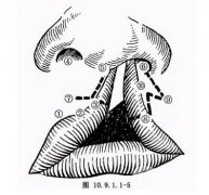 唇腭裂修復(fù)果好嗎?唇腭裂手術(shù)后有哪些注意事項(xiàng)?