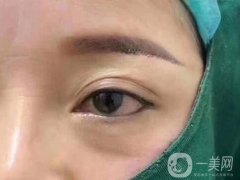提眉術(shù)的原理是什么?哪些人可以做提眉術(shù)?